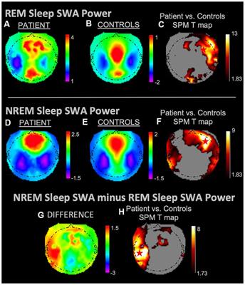 Local Sleep Slow-Wave Activity Colocalizes With the Ictal Symptomatogenic Zone in a Patient With Reflex Epilepsy: A High-Density EEG Study